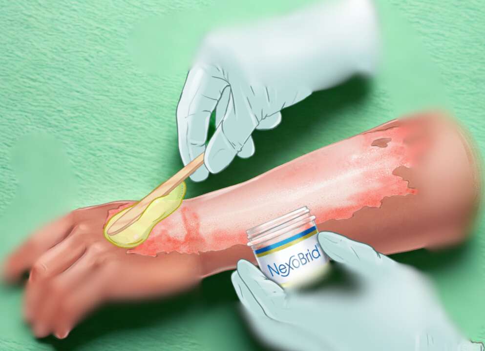 2026 e la crisi del Nexobrid il farmaco per le ustioni tra emergenza, innovazione e vita reale 1